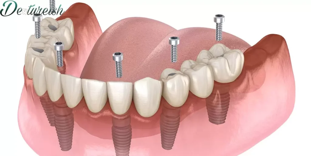 What Is A Single Arch Denture