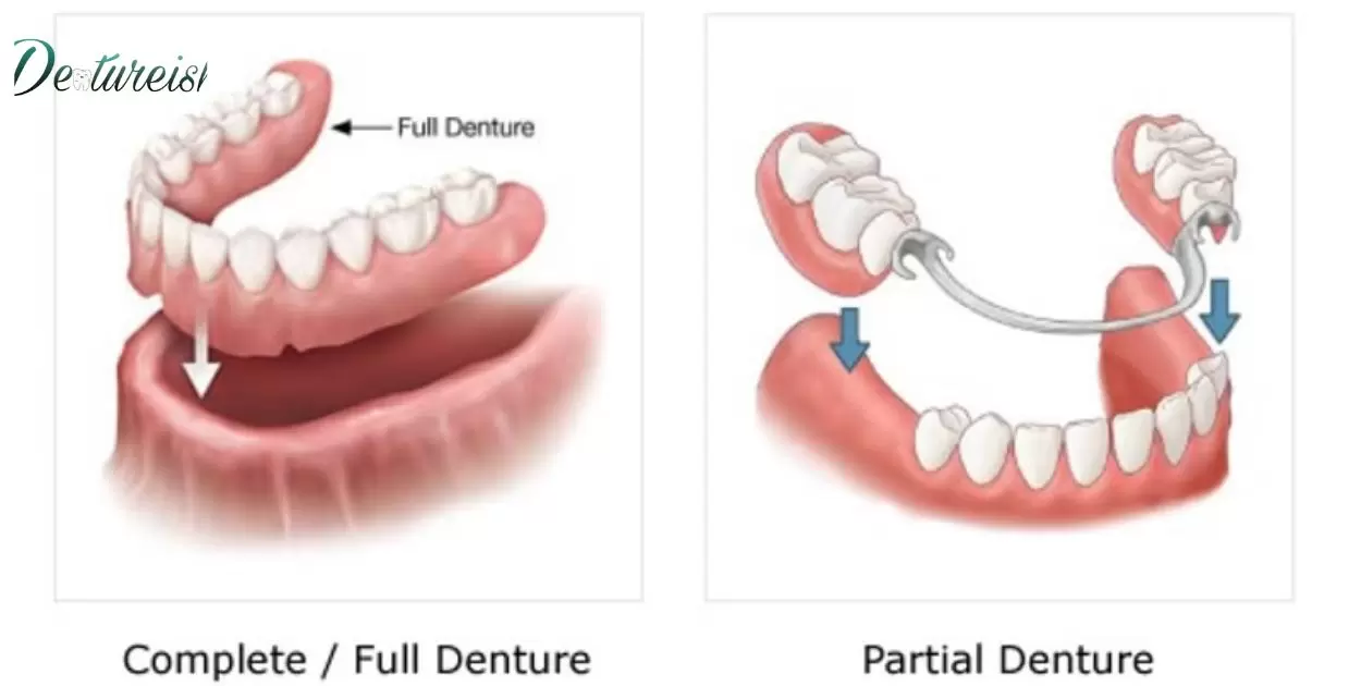 What Is the Process For Getting Partial Dentures?