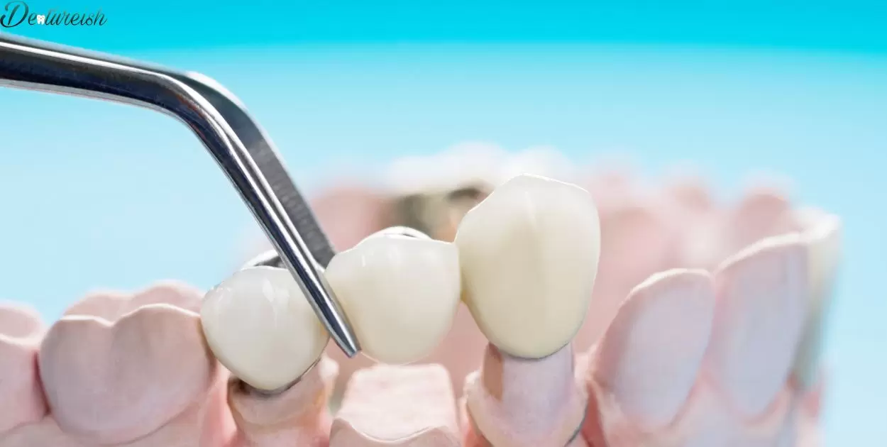 Denture Placement Process Explained