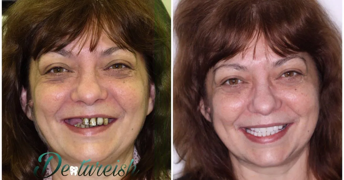 Full Immediate Dentures Before And After