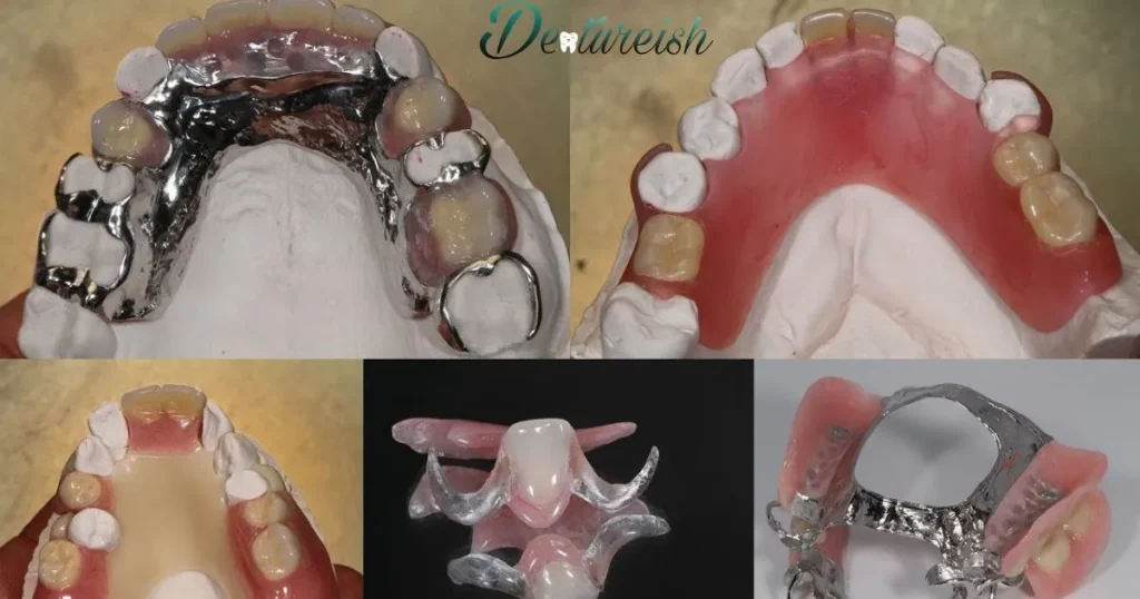 implants differ from removable partial dentures