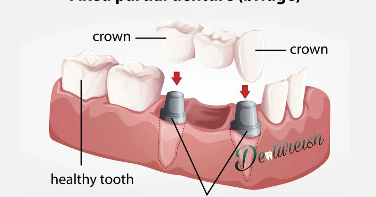 How does caring for your partial denture affect your oral health?