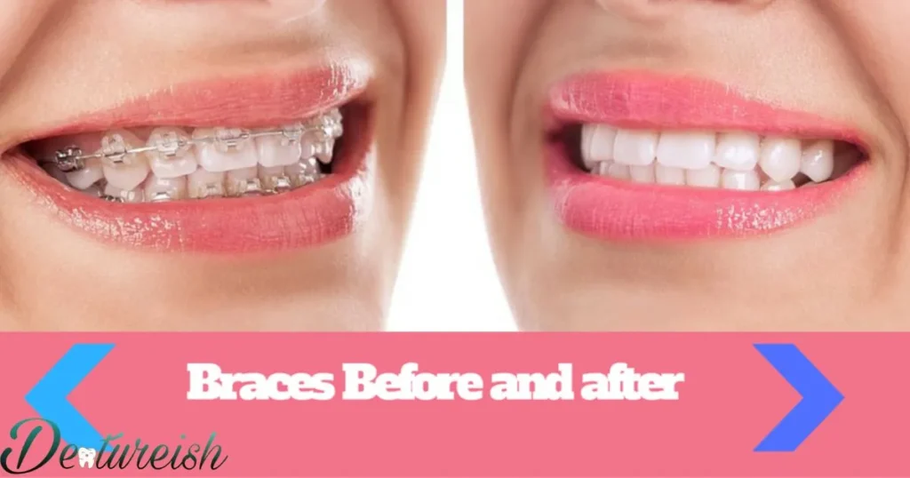 Braces Key: Caring For Lips After Braces Removal