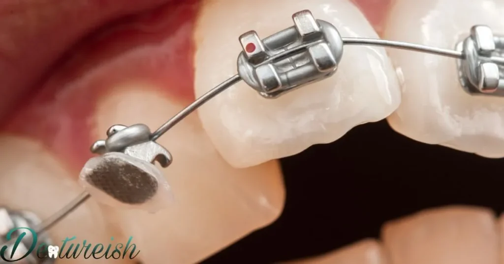 Braces Key How can Braces Wires be Maintained?
