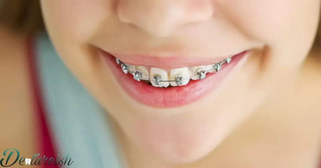Braces Key: What Are Options For Maintaining Results After Braces?