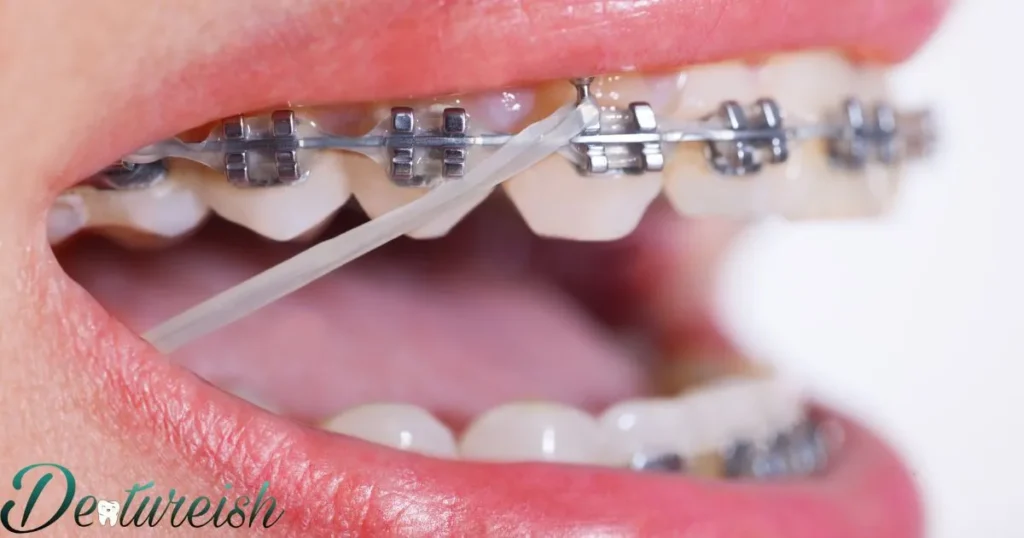 Braces Key What Materials Are Used For Braces Wires?