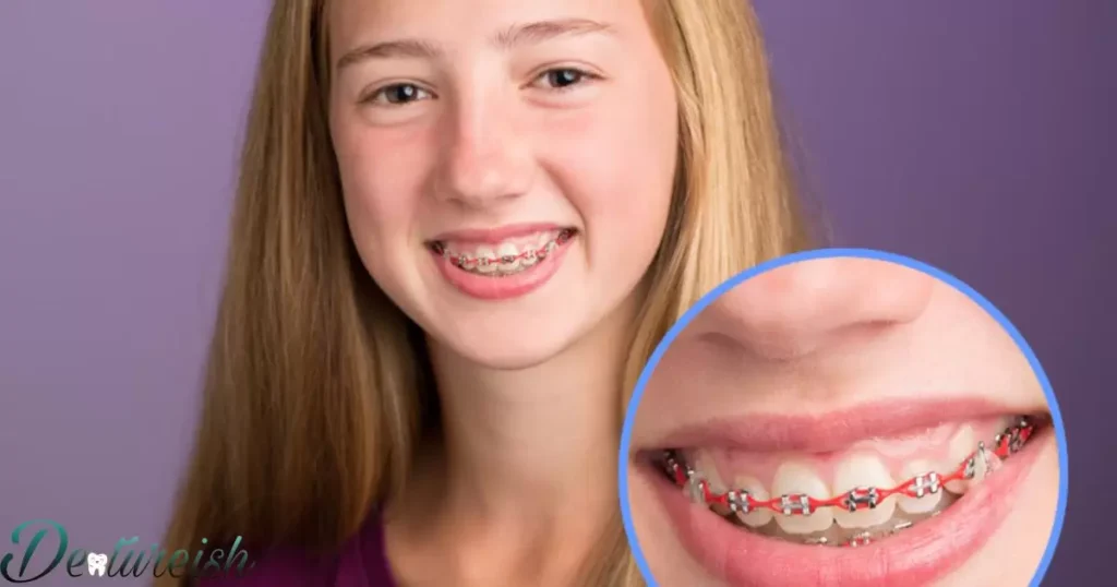 Braces Key: Who is responsible for braces costs after a divorce?