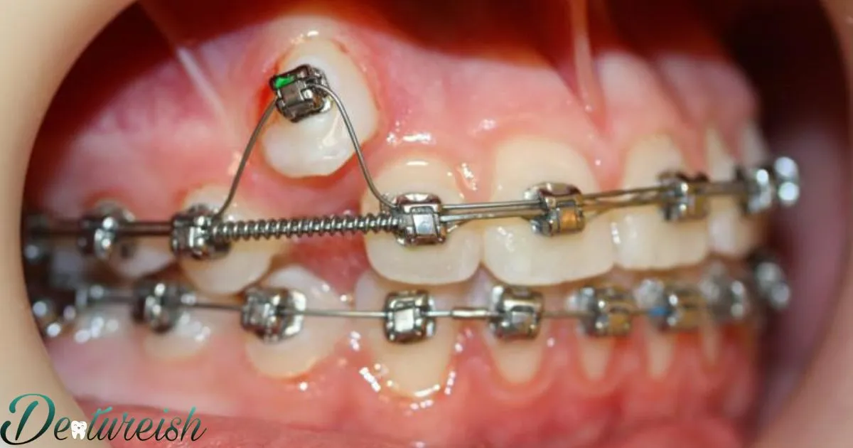 Braces Removal Cost