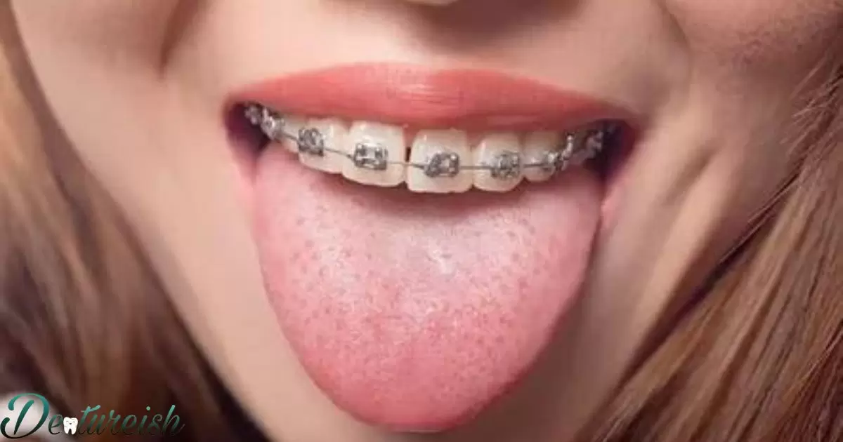 Braces Tongue Ring