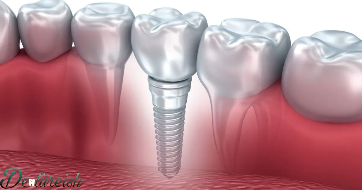 Dental Implants And Dentures