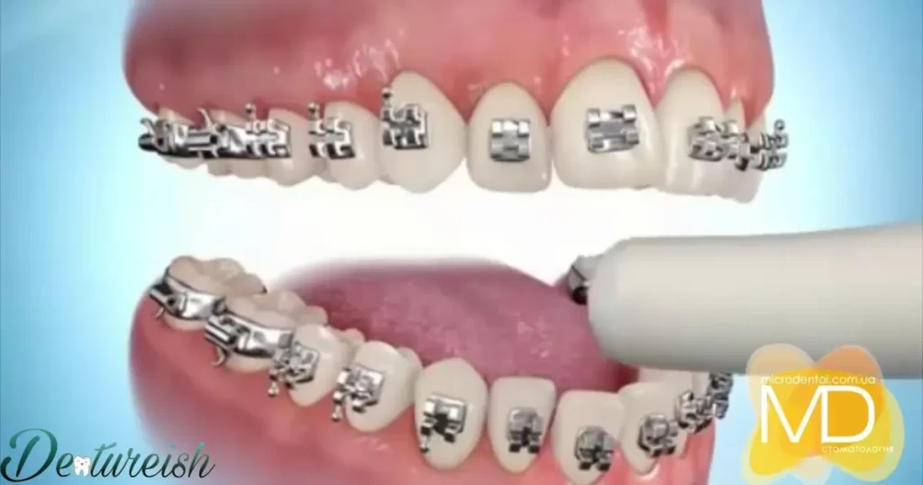 How Does The Procedure Of Braces Removal Work?