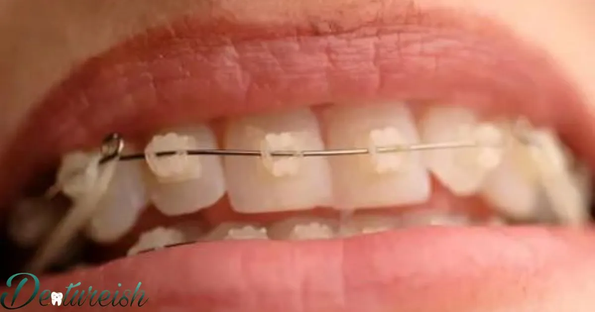 How Long Is The Detailing Stage Of Braces?