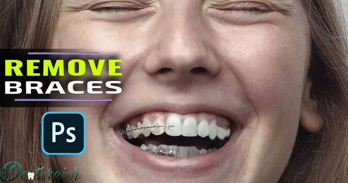 Is Braces Removal