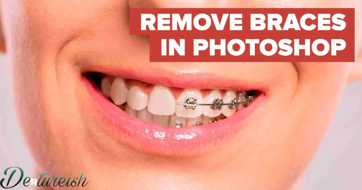 How Much To Remove Braces?