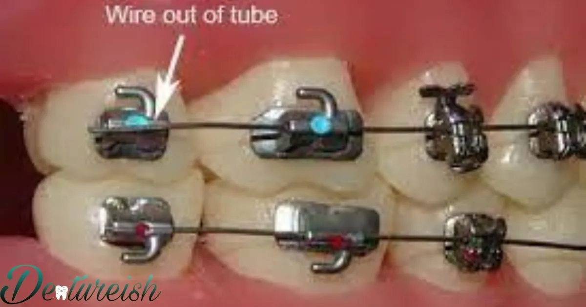 Put The Wire Back In Braces