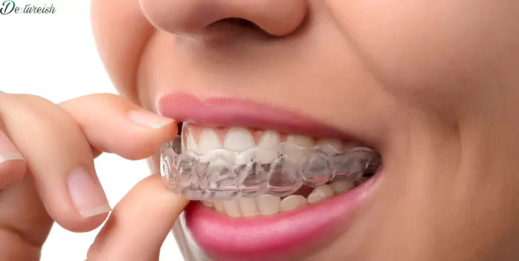 Advantages Of Clear Aligners