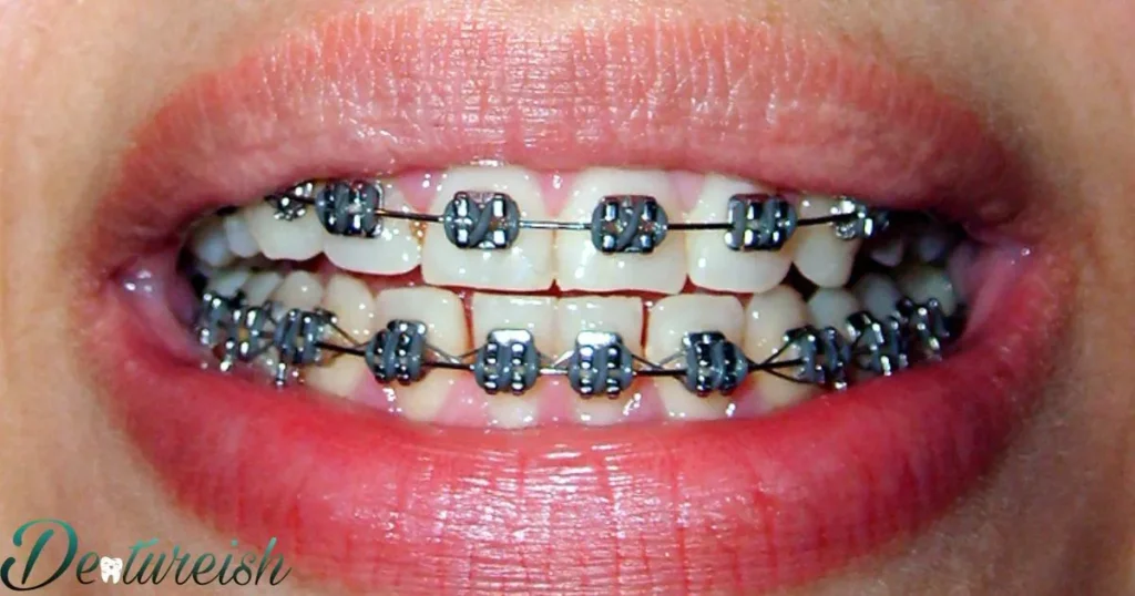 Are Aesthetic Metal Braces Better Than Traditional Braces?