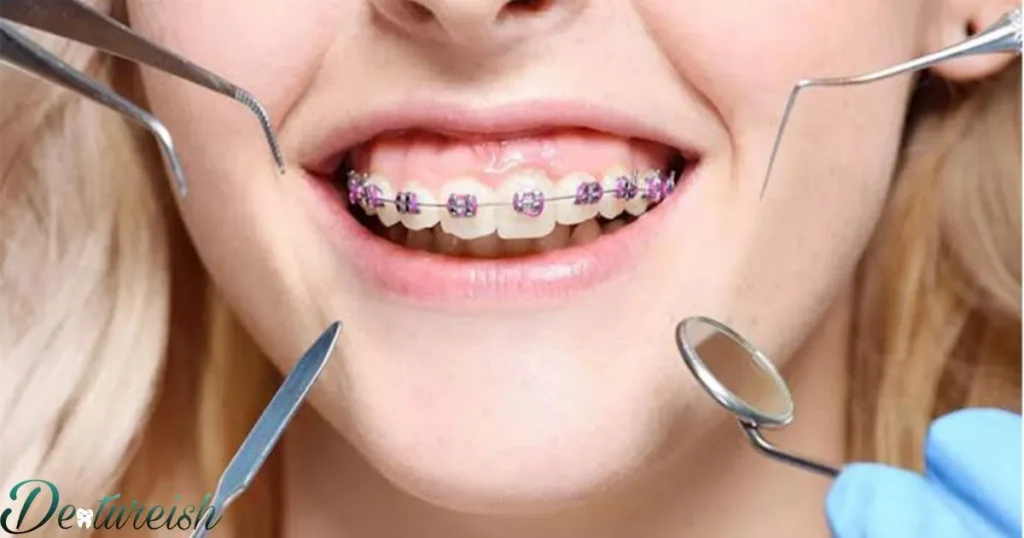 Braces Keys: Getting The Balance Between Treating And Treatment
