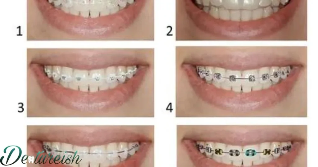 Cost Comparison Of Braces Types