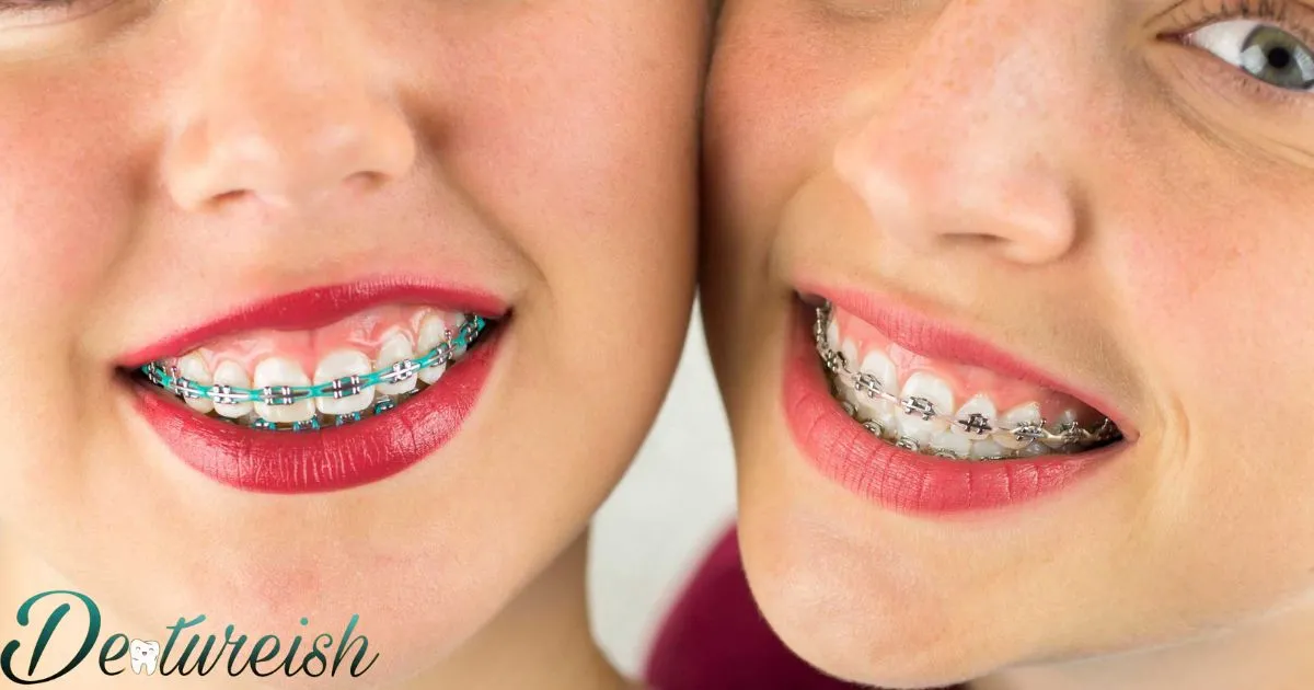 Different Kinds Of Braces For Your Teeth
