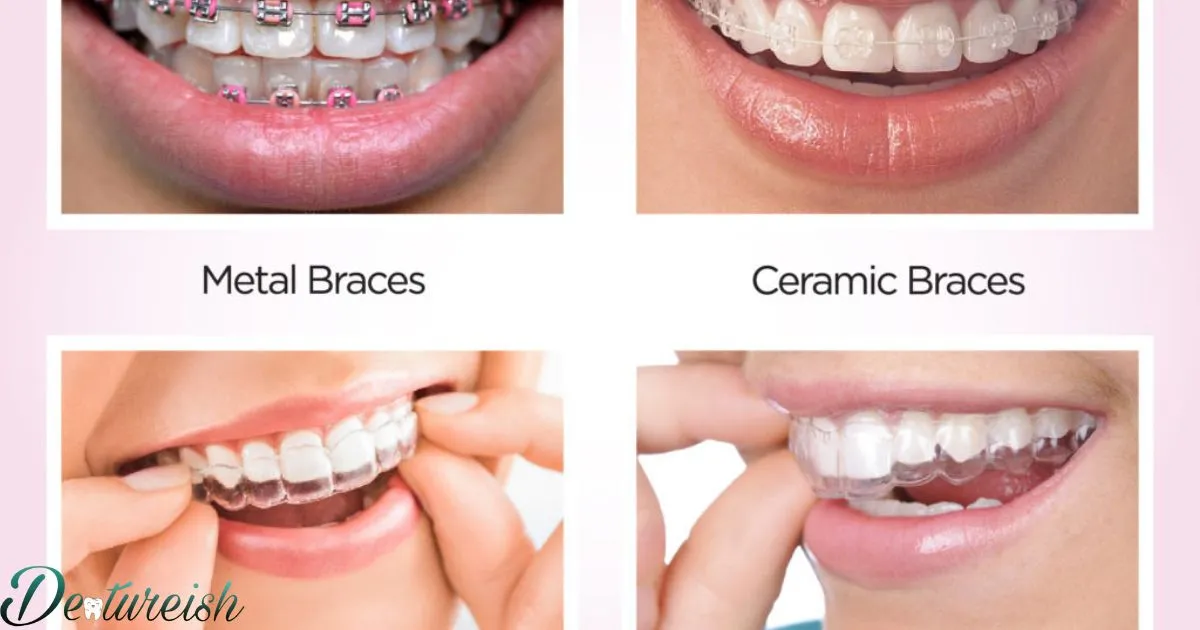 Different Kinds Of Dental Braces