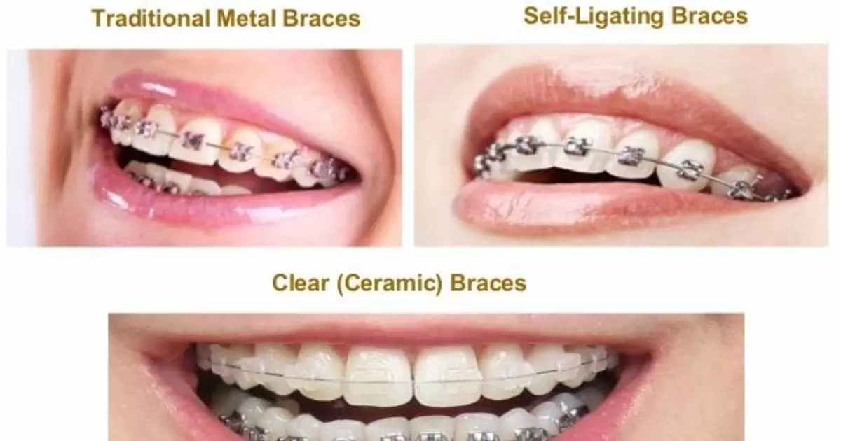 Different Kinds Of Metal Braces