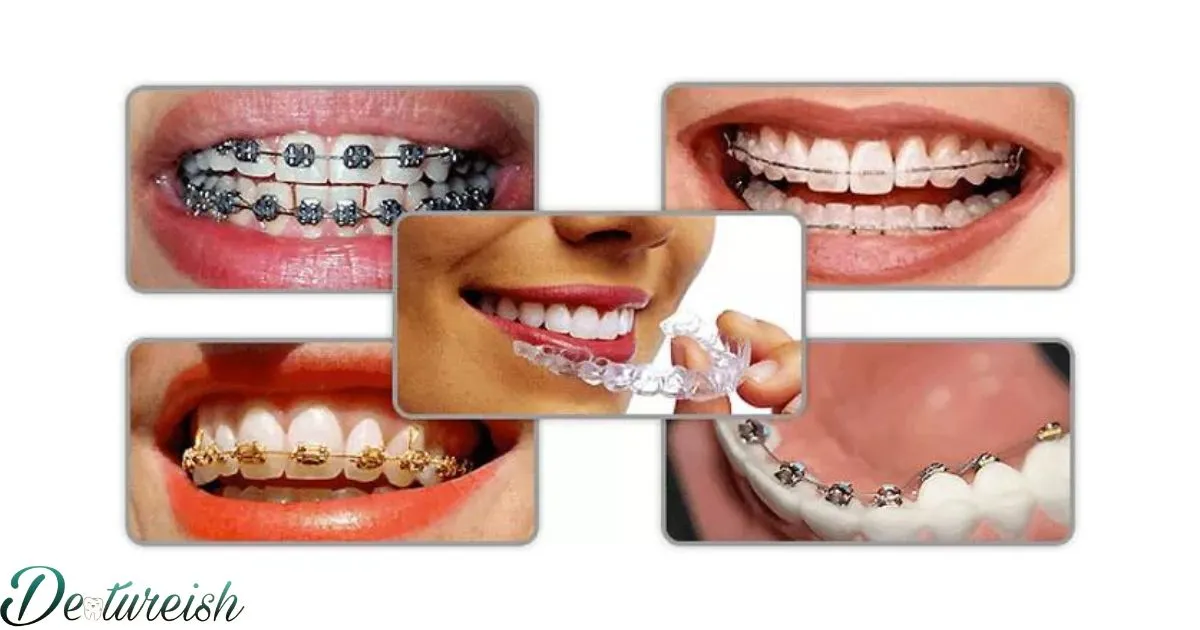 Different Styles Of Braces For Teeth