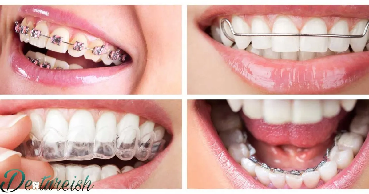 Different Types Of Braces Brackets