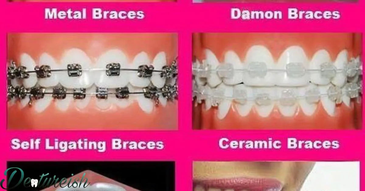 Different Types Of Metal Braces