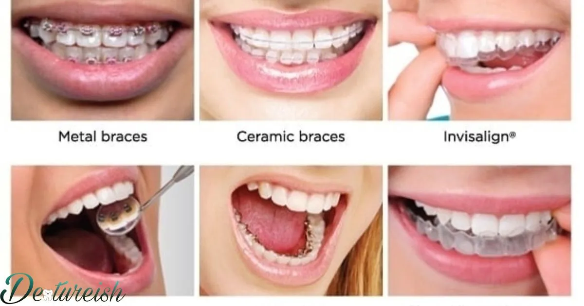 Different Types Of Teeth Braces