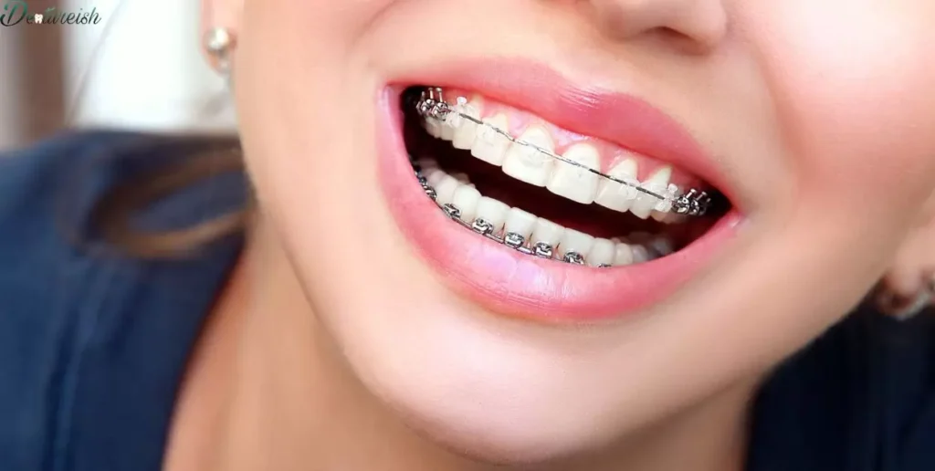 Do Braces Come In Different Materials?