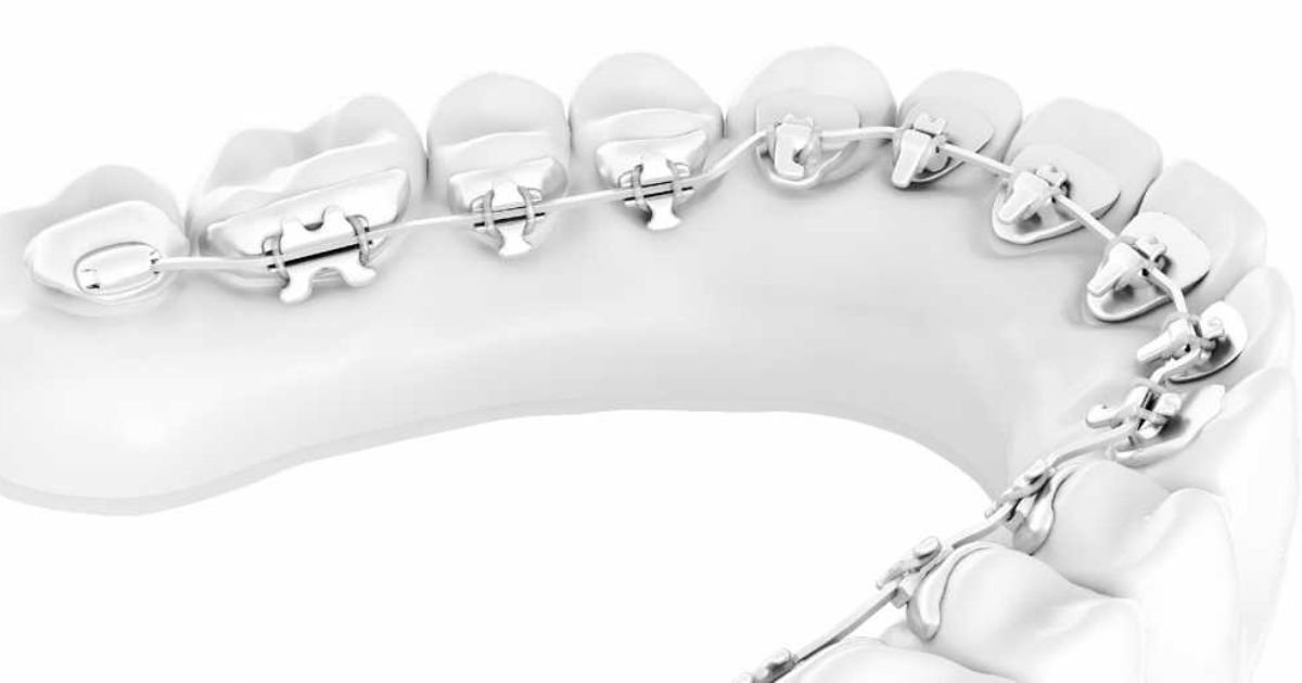kinds of braces for teeth