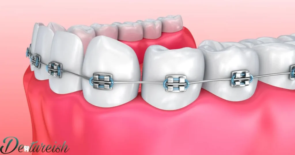 Lingual Braces: Straight Teeth With A Undetectable Look