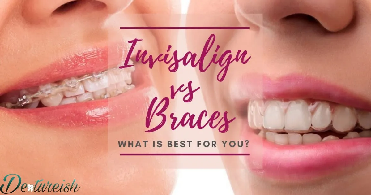 Lingual Braces Vs Traditional Braces