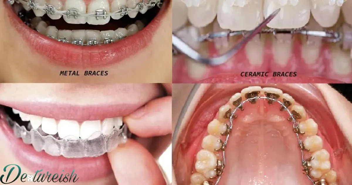 Types Of Braces For Teeth