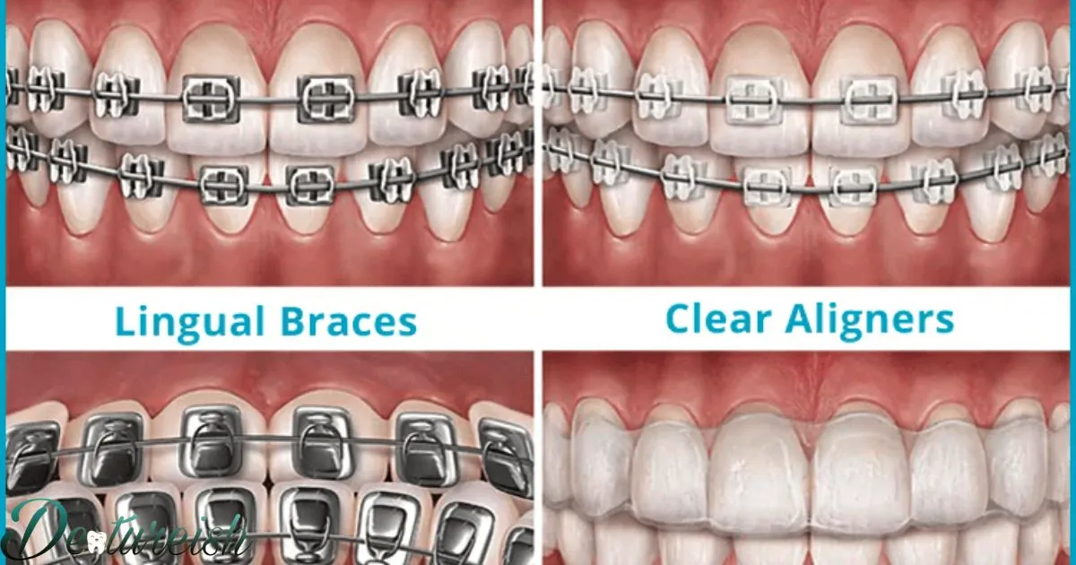 Types Of Dental Braces Pictures