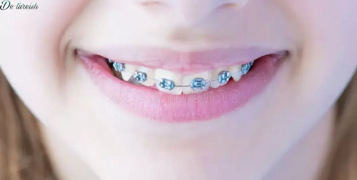 What Are All The Different Types Of Braces?