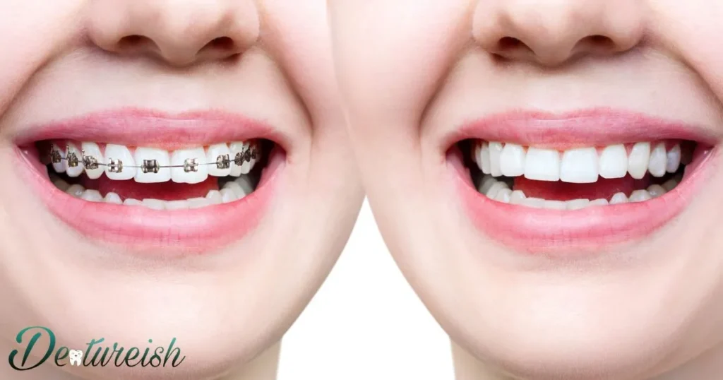 What Are Normal Braces?