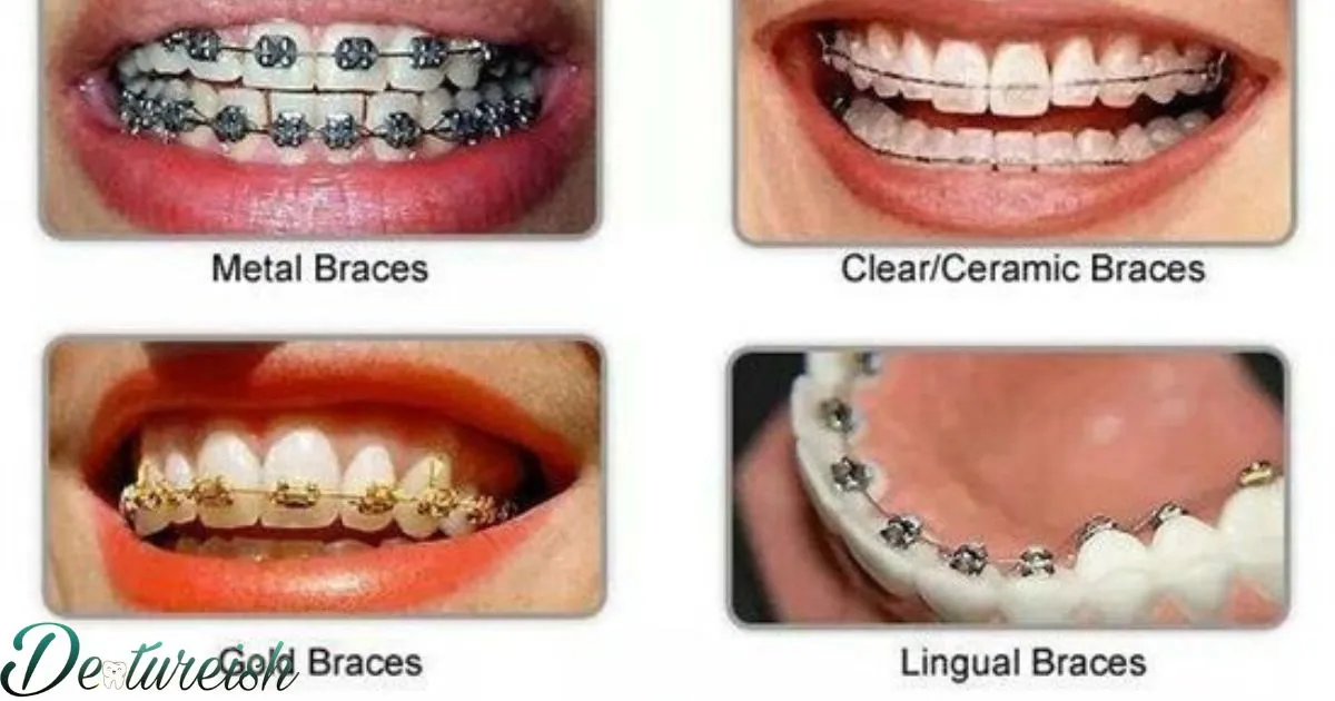 What Are The Different Kinds Of Braces?