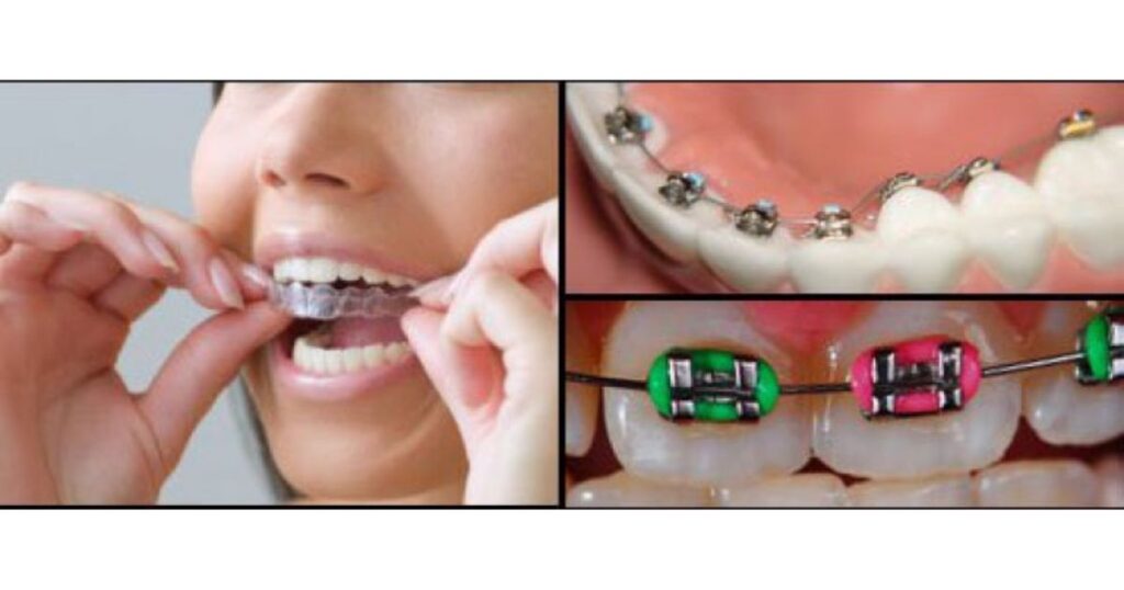 What Are The Different Types Of Braces?