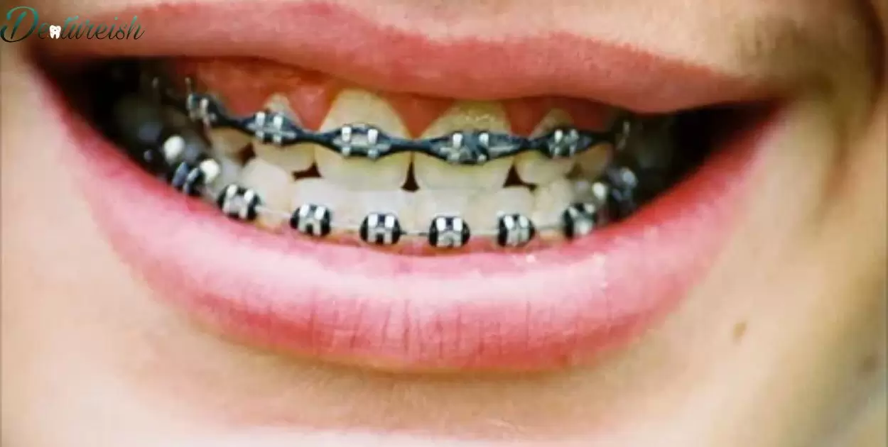 What Type Of Braces Are There?