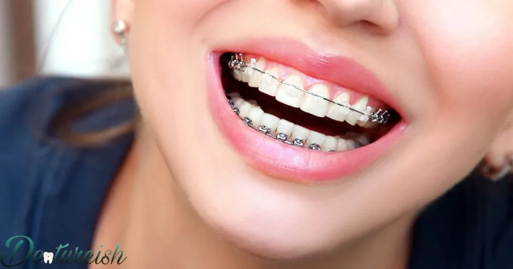 When Are Metal Braces Considered The Only Option By Orthodontists?