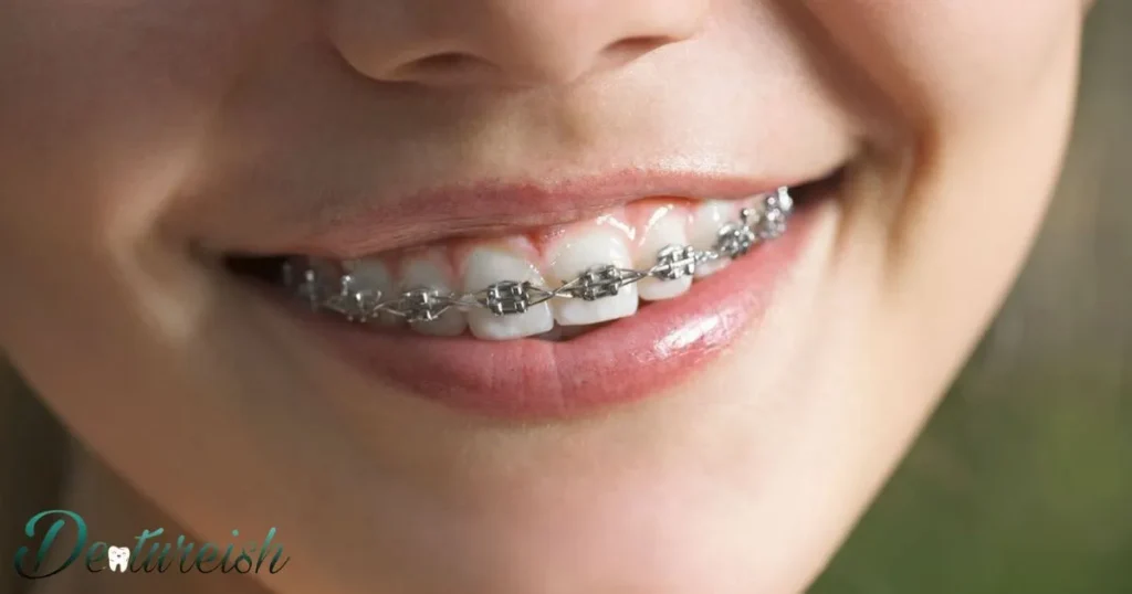 Which Braces Have Better Results?
