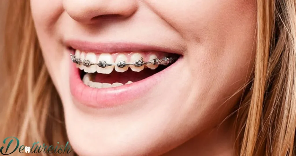 Which Braces Option Is Best For You?